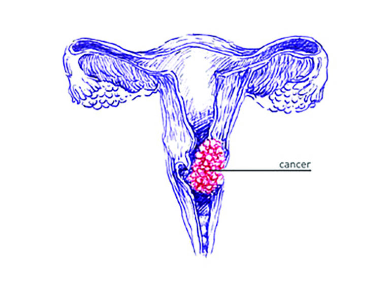 Cervical cancer kills over 360 women annually