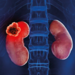 kidney cancer