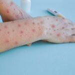 Measles: Deaths drop 88% since 2000, but cases surge to 11 million worldwide Global-Measles-Deaths-Fall-88-But-Cases-Surge-to-11-Million-WHO-Report-696x438